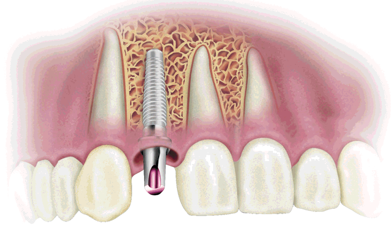 Injertos óseos para implantes dentales
